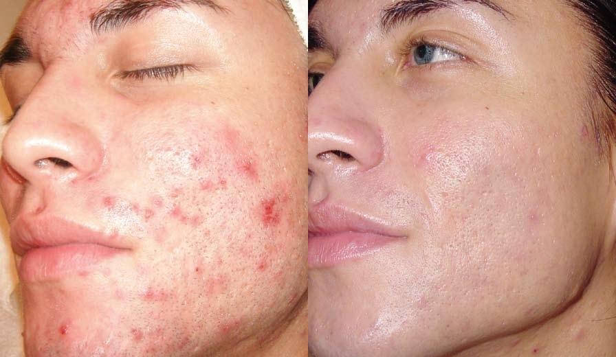 Man's acne condition of before and after microderm treatment