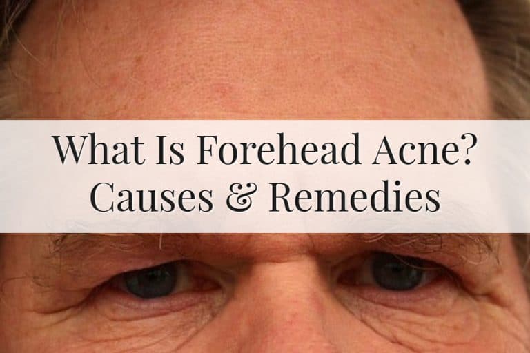 Forehead Acne Causes and Remedies Feature Image
